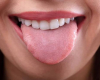 Dildəki yaralar nəyin əlaməti ola bilər?