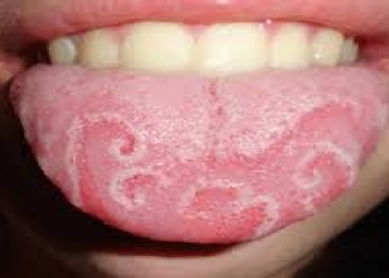 Hansı vitamin çatışmazlığı dilin ağarmasına səbəb olur?