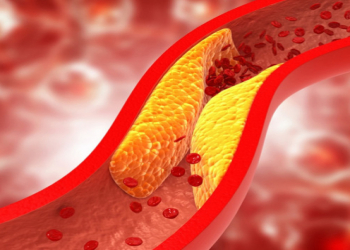 Xolesterini azaltmaq üçün gündəlik 4 sadə vərdiş