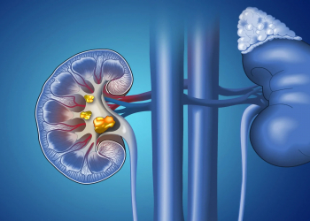 Böyrək daşlarının yaranmasına təsir edən qidalar açıqlanıb