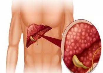 Öd daşı olanlar üçün qidalanma qaydaları açıqlanıb