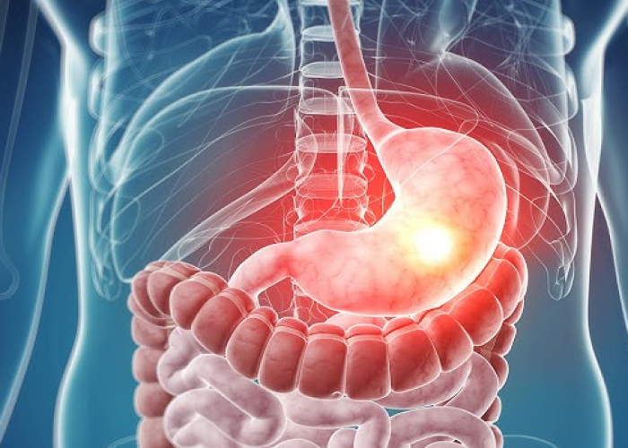 Mədə turşuluğunu artıran qidalar açıqlanıb – bunlardan uzaq durun