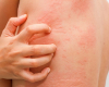 Yay aylarında allergik reaksiya niyə artır? – Dermatoloqdan xəbərdarlıq