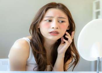 Dermatoloq istidə sızanaqların səbəblərini açıqlayıb