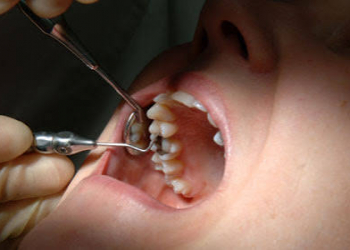 Sadə bir diş çürüməsi nələrə səbəb ola bilər?