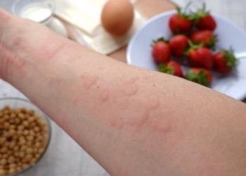 Qida allergiyaları: Nələri nəzərə almalıyıq?