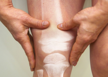 Osteoporozda diyetə resveratrol əlavə etmək faydalıdır