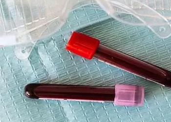 Həkim D vitamini çatışmazlığının əlamətlərini açıqladı