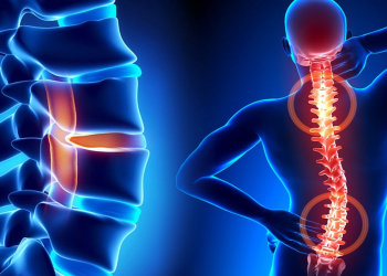 Faset sindromu nədir və necə müalicə olunur?