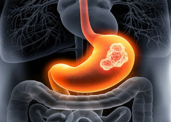 Mədə xərçənginin qarşısını almaq mümkündür