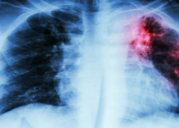 Sadə vərdişlər sağlamlığı qoruyur: vərəm riskini azaltmağın 3 yolu