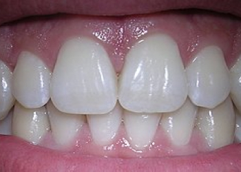 Sağlam diş ətləri üçün ən faydalı 10 məhsul