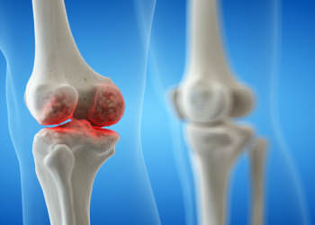 Cəmi 3 sadə hərəkət oynaq ağrılarını azaldır