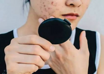 Şokolad sızanaq yaradırmı?