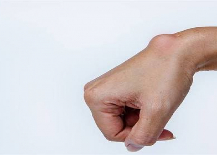 Bədəndə şişlərin yaranma səbəbləri nələrdir?